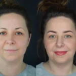 Metamorfoza przed i po kobiety po makijażu permanentnym w US Clinic Wrocław
